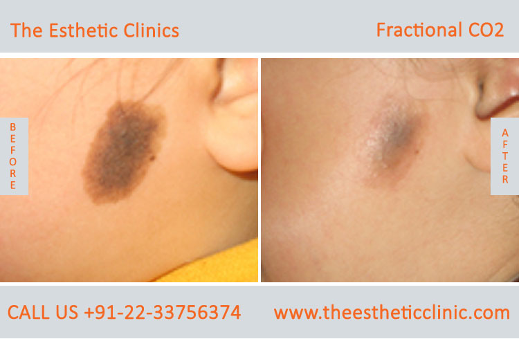 Fractional Co2 Laser Skin Resurfacing Treatment before after photos in mumbai india (4)